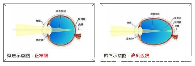 防范|权威提醒：近视度数不断增加或致盲，高度近视需引起重视和防范