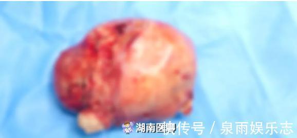 手术|子宫肌瘤号称“妇科第一瘤”!当出现这些症状时,您就该警惕了