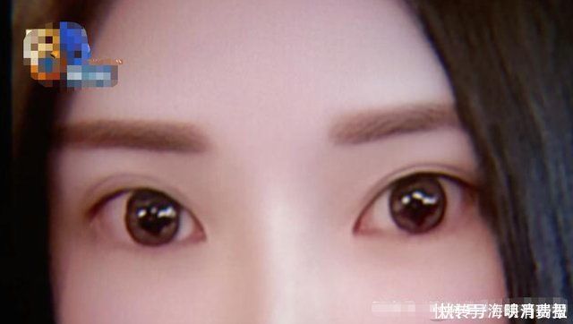 双眼皮|女子做完整容手术后，频繁眨眼睛，经常“泪流满面”