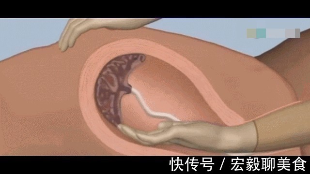 妈妈|为什么有些产妇生完孩子后,胎盘不能自动娩出,还需要手剥胎盘