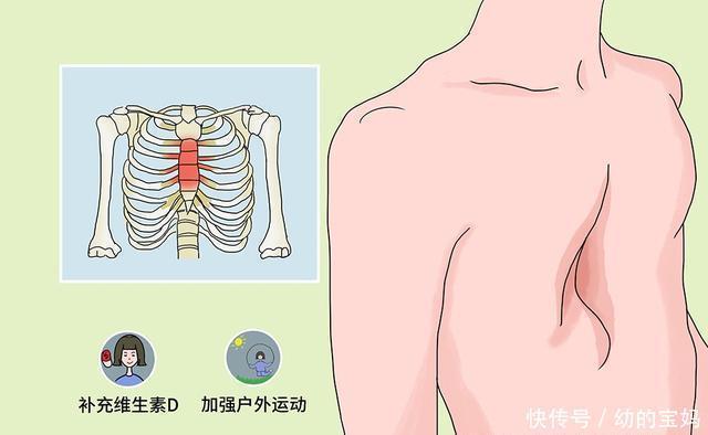 村里的孩子诊断为鸡胸,是缺钙引起的吗?如何预防孩子鸡胸?