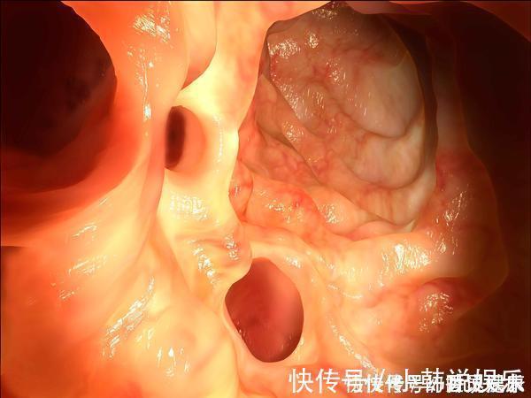 胆囊炎|息肉和癌症有什么关系告诫3个部位长息肉,最好及时切除