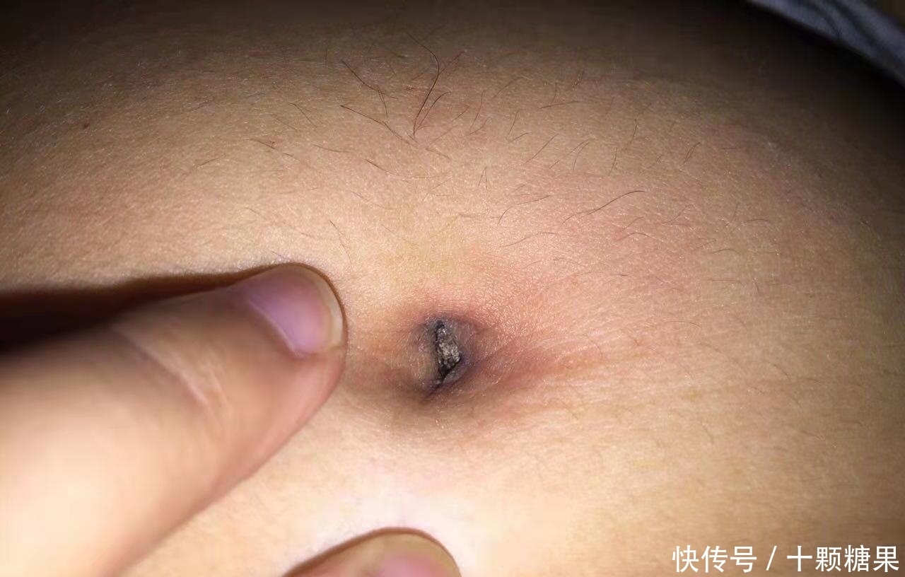 肚脐的黑泥不能清理,否则会进风、漏气、烂肠子?医生辟谣说清楚