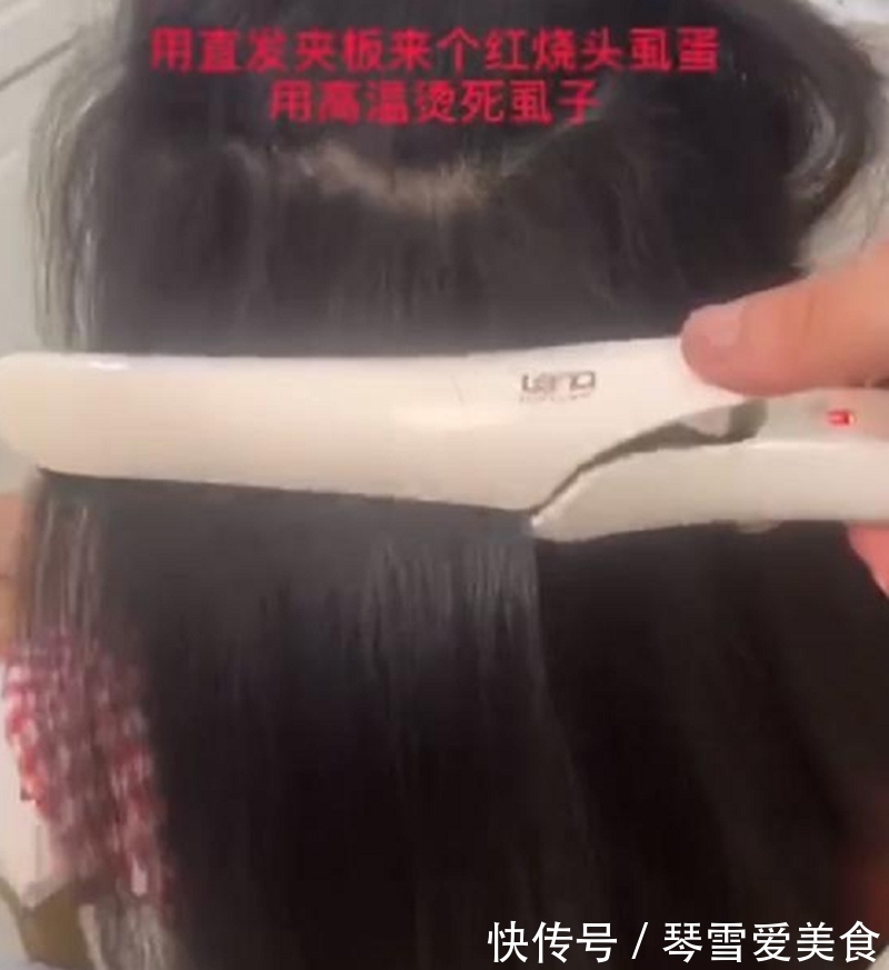 孩子|女儿住校被染上了头虱，妈妈用了这个方法后，虱子和虫卵被一锅端