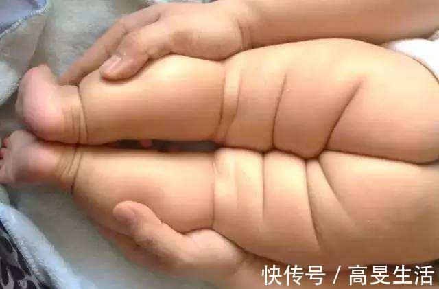 腿纹|8个月宝宝的腿纹不一致,一家人发现的太晚,结果错过最佳治疗期