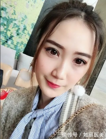 褶皱 做完双眼皮手术后老气?这2个因素帮你盘点盘点