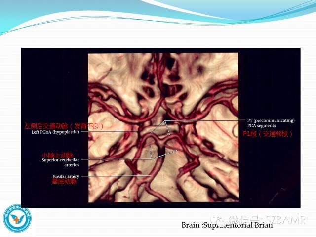 mr|椎-基底动脉系统解剖