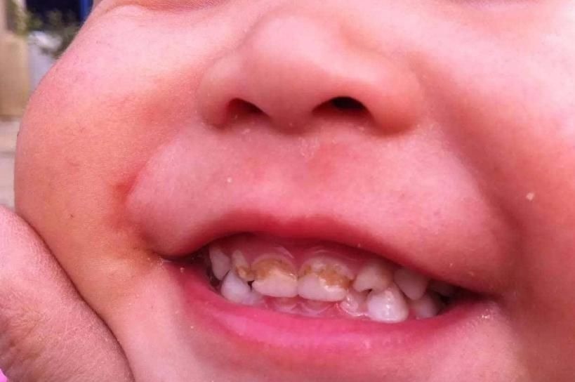 宝宝|4岁孩子一嘴黑牙，妈妈毫不在意认为牙齿能换，牙医叹气无知