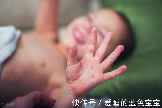 71型|入冬后,“手足口病”又出来猛刷存在感了,我们该如何预防