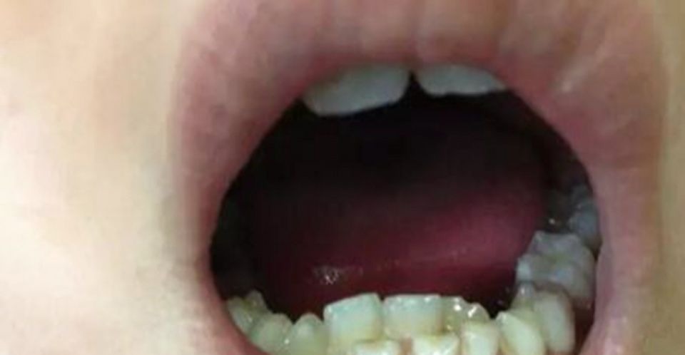 双排牙|7岁的我有一个女孩,奶奶说这是祝福的表示,医生的责备感到羞愧