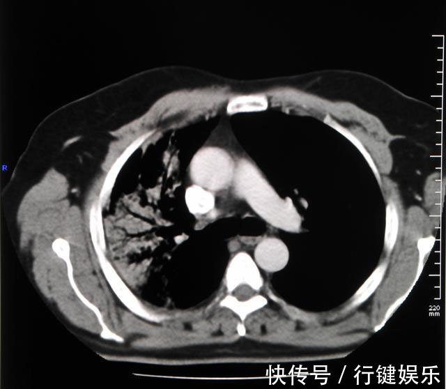 中华医学会|三个月前体检健健康康，三个月后诊断晚期肺癌，已经遇到不止一例