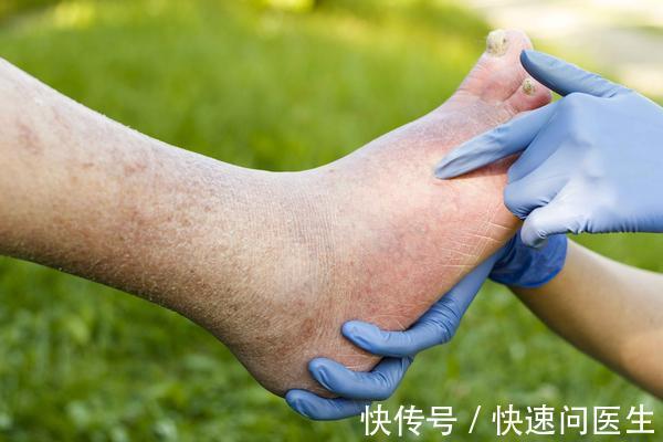 形状|赤小豆和红豆到底有何区别?吃对了,不仅利水消肿,还能健脾养胃