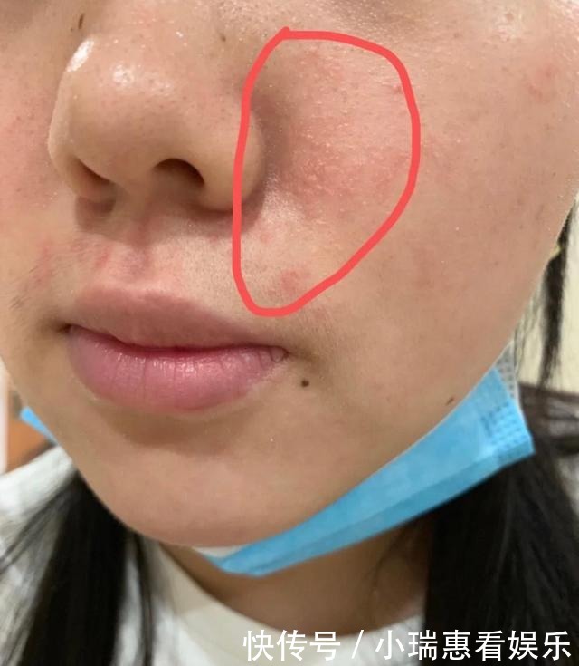 防晒|夏季涂防晒容易过敏?别直接上脸涂,记住做好这几件事!