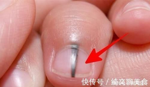 黑线|指甲里的黑线是什么？真有1种可能会癌变，不是开玩笑，别小瞧