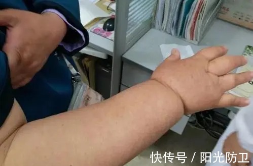 淋巴水肿|乳腺癌术后胳膊抬不起？担心淋巴水肿？应该如何治疗？