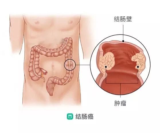 腹泻|不便秘不腹泻,32岁女子突然便血,一查竟是肠癌!