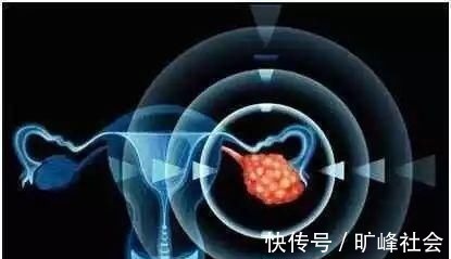 女性|发现妇科病一定要治疗吗?提醒:此3种“疾病”一般不用治