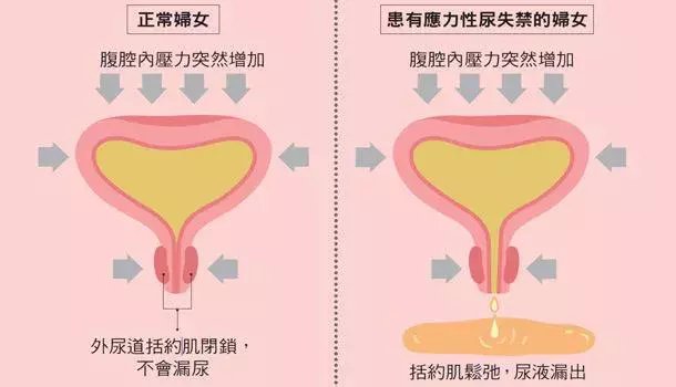 手术治疗|关注女性尿失禁，远离“社交癌”