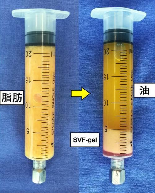 你的眼皮都有几层了?