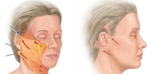 不到50岁就老成大妈？小拉皮术后6个月轻松实现逆生长！