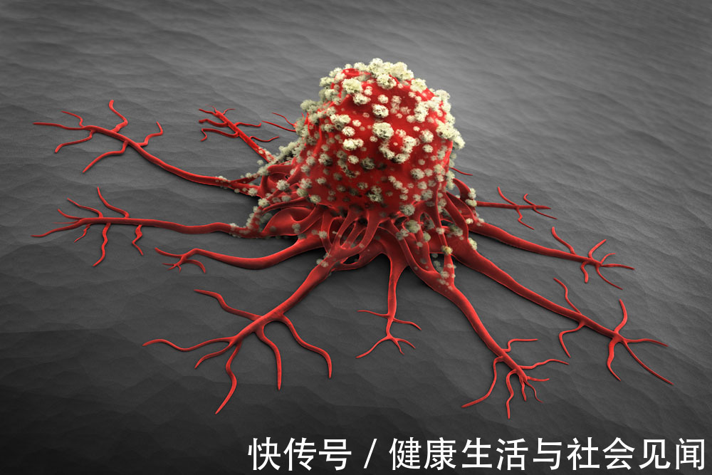 得癌|于加军答:为什么会得癌?"癌"究竟是什么?