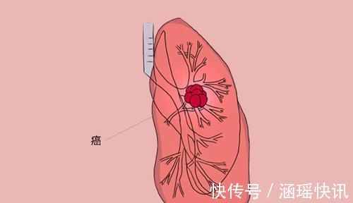 放疗|女子肺癌7年,两次发生转移,都死里逃生,她的抗癌方法值得学习