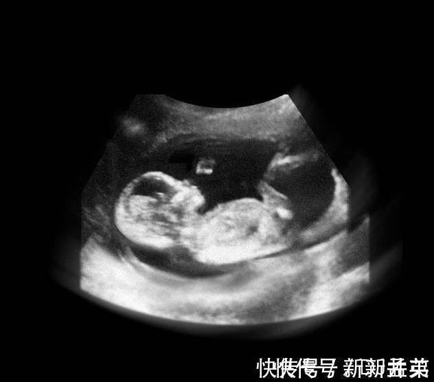 羊水|胎儿从卵泡到性别形成,17张图片清晰诠释,男宝女宝看得很清楚