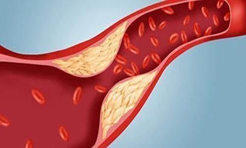 高血脂患者|身体出现这4个迹象,说明你的血脂超标了,别让心梗趁虚而入!