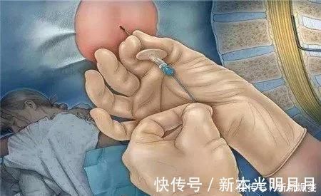 自然分娩|剖腹产到底是怎么“剖”的一组图看清全过程,每个妈妈都是超人
