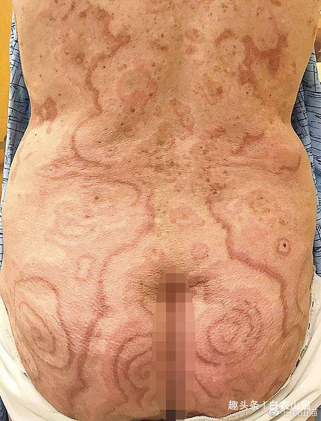 病人|注意，如有人出现这种皮纹，往往提示他内脏有癌！