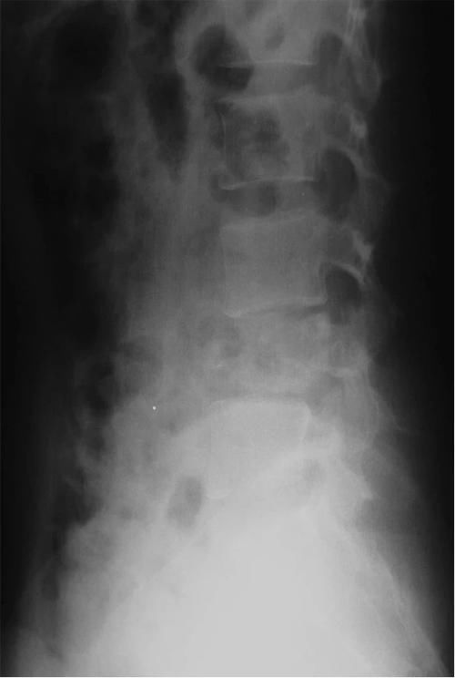 椎体|脊柱常见肿瘤及肿瘤样病变的几种影像学表现,你都见过吗?