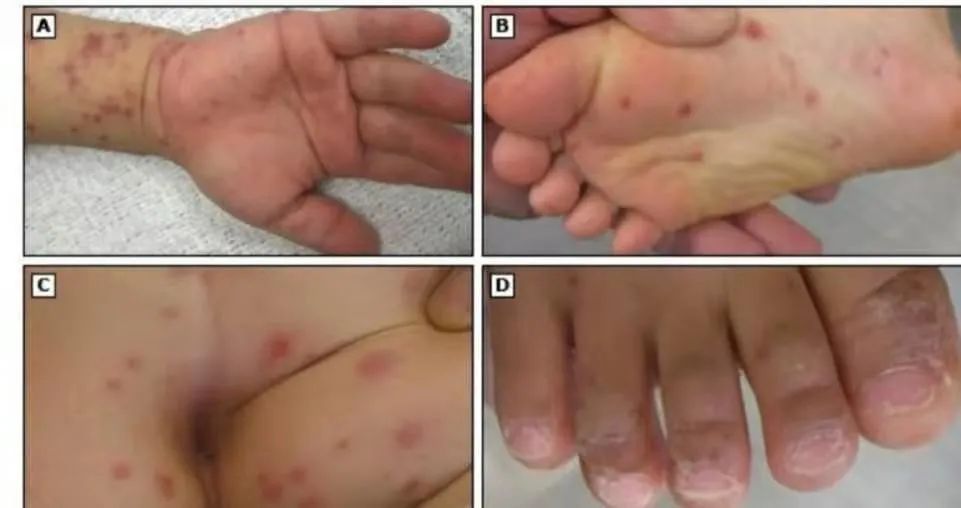 肠道病毒|手足口病、疱疹性咽峡炎夏秋季高发，家长需注意！