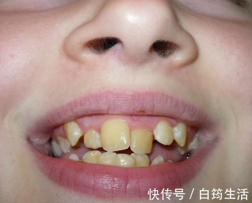 换牙|孩子换牙齿,新长的牙齿却是歪的,可能是家长这些没做好