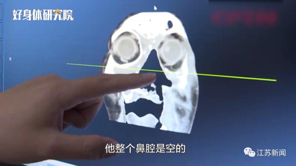 鼻子|八旬大爷鼻子发痒,医生竟从里面取出36条蛆