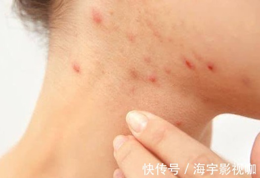 蒲公英水|17岁女生因一壶蒲公英水,送入医院,提醒蒲公英泡水有4大禁忌