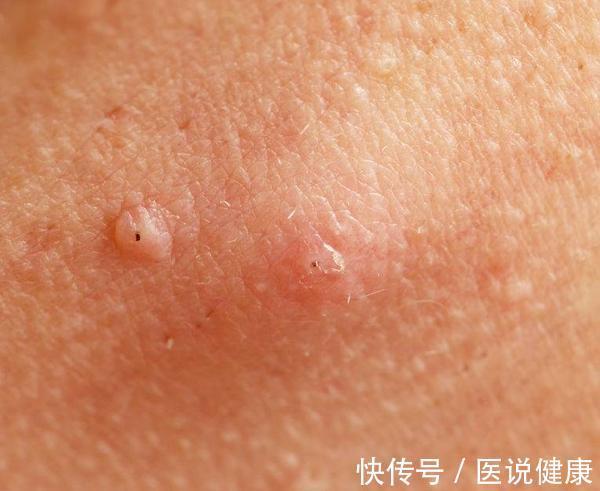 丘疹|当毛囊炎到来时,身体会出现4个表现,留意到一个,也要重视