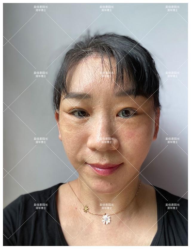 面部 51岁小拉皮术后1个月,我想跟大家说点真心话