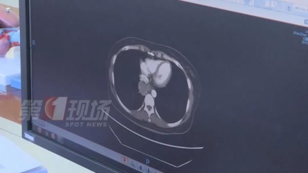 胸外科|手指肿成“萝卜头”，一查竟是肺癌！警惕身体发出的这些信号