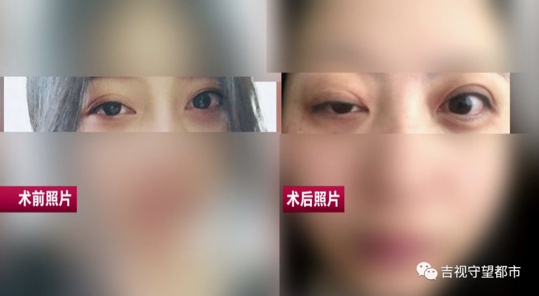 瑞鑫医院|女子整容前后对比图令人诧异！医院还关门了