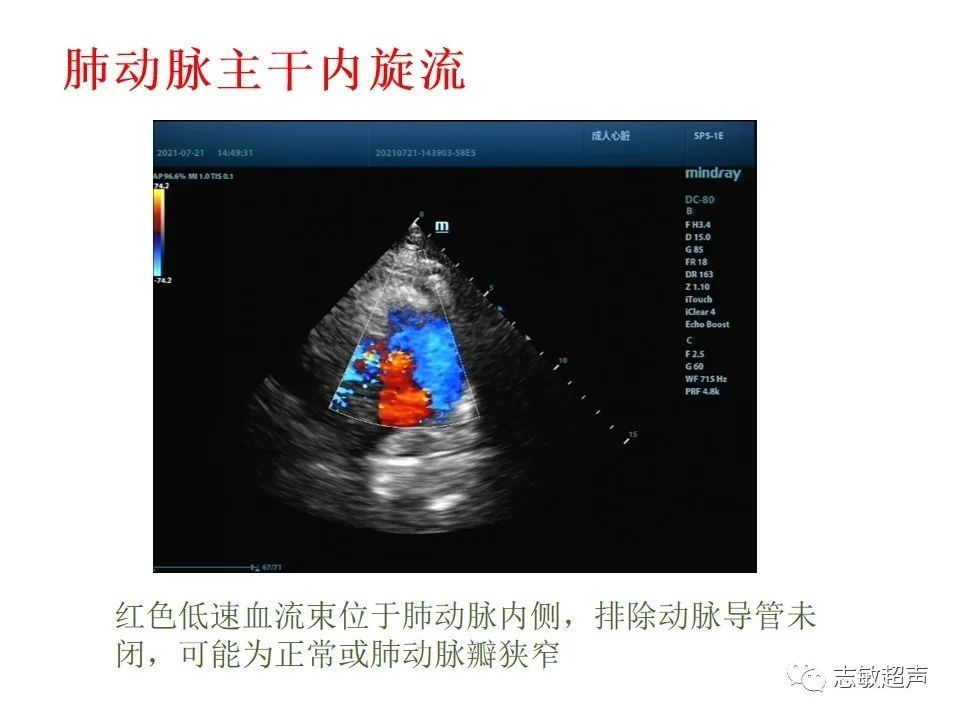超声|肺动脉瓣周边异常血流的超声鉴别