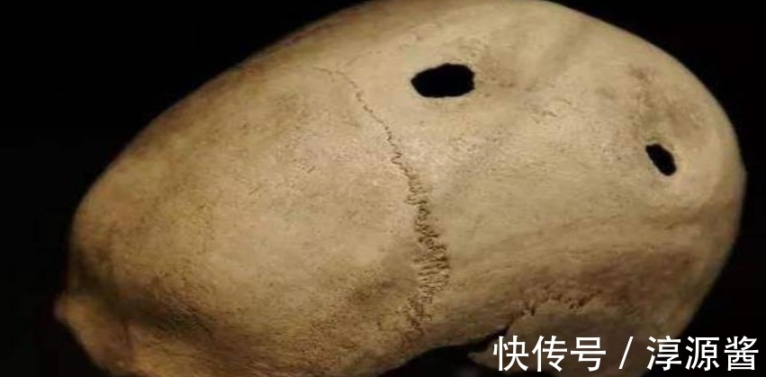 头骨&侯家窑遗址出土带孔颅骨,古人实施环钻术,应该用了这种工具