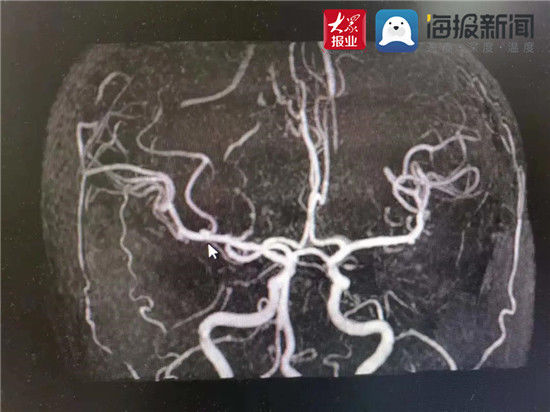 神经外科|44岁女士晕倒、意识丧失世博高新医院成功摘除颅内“定时炸弹”