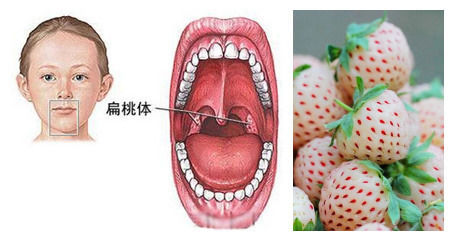 10岁男孩持续口臭，竟然是扁桃体结石在作怪，家长别不当回事