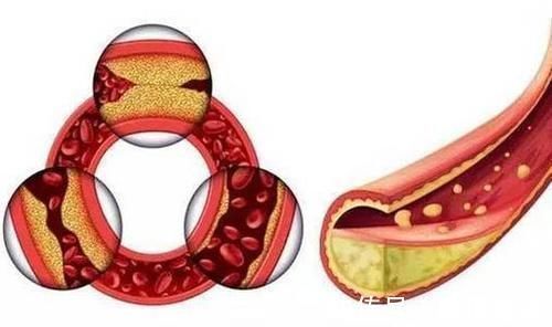 医生|不管高血脂多久,医生春天坚持3件事,养血管调血脂,人更精神