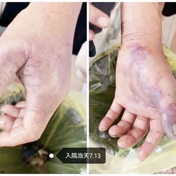 截肢|大爷被这种物品叫刺伤,拇指截肢险丧命,处理它一定要小心!
