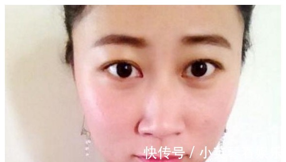 肿眼泡|割了双眼皮的人,老了之后会变成什么样子?可能很多人不知道吧?