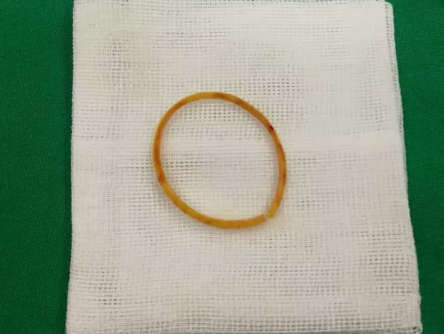 橡皮筋|4岁女孩得怪病,医生检查后,忍不住训斥父母心真大