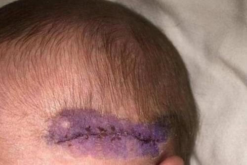剖腹产|剖腹产划伤宝宝,宝妈声讨无果,若想避免,准妈妈要注意这几点