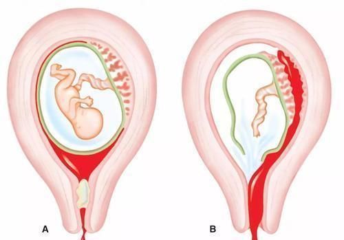 疾病|糟蹋子宫的这几种行为，现在还不改掉，当心以后疾病“找上门”