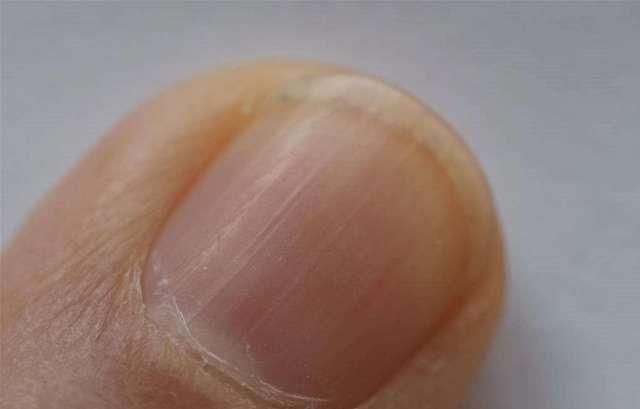 肝脏|指甲上有“竖纹”,可能是这4种情况,别忽略身体的“求救信号”